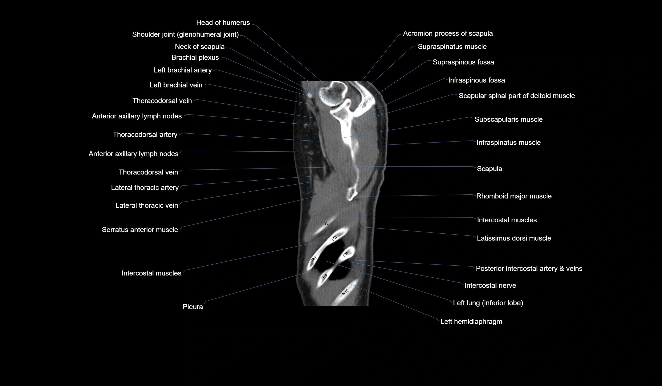 CT chest (thorax) labelled sagittal cross sectional anatomy radiology image-00133.webp